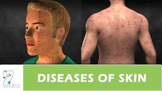 DISEASES OF SKIN