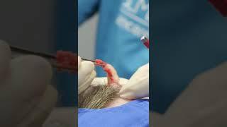 Craziest Pops Compilation 🫣‍ | Dr. Pimple Popper | TLC