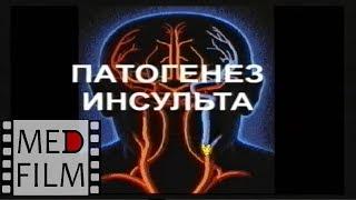 Патогенез инсульта: инфаркт мозга, кровоизлияние, тромб сосудов © Pathogenesis of stroke