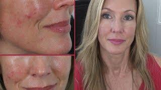 My Anti Aging Skincare Routine for Clear Skin ~ Acne Update