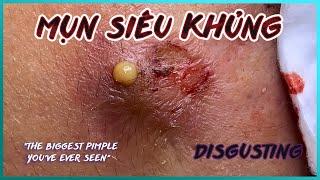 Big Cystic Acne Blackheads Extraction Blackheads & Milia, Whiteheads Removal Pimple Popping