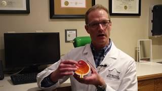 Dr. Tyson Schwiesow, MD, explains Laser Vitreolysis in relation to floaters