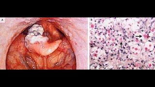 Larynxbeteiligung bei disseminierter Kryptokokkose