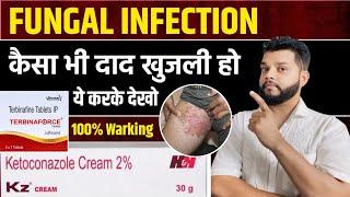 दाद खुजली ठीक नही हो रहा क्या | Fungal Infection allopathic Treatment In Hindi | Gyanear