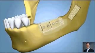 Ramus Graft with Dental Implants  | Implant Dentist