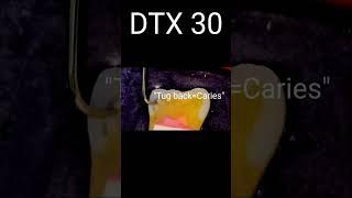 DTX 30 Disto-occlusal caries #acadental #dentistry #ADEX #DTX #DTX30