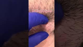 #skincare #blackheadremoval inclusion cyst