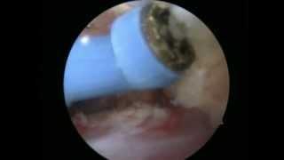 Rotator Cuff Repair & Surgery - Orthopedic Surgeon Dr. Alejandro Badia - Part 2