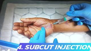 Step-by-Step Guide: Administering Local Anaesthesia for Carpal Tunnel Decompression