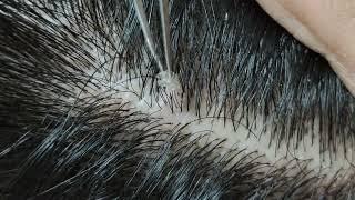 Relaxing dandruff removal (w/ tweezers) #15 02sleepyheads | visual ASMR #oddlysatisfying