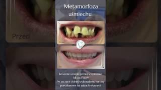 Piękna metamorfoza uśmiechu naszej pacjentki  #dentalcentrum #dentysta #stomatologiapodnarkozą