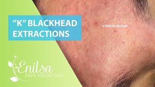 Special "K" Blackhead Extractions 11th Treatment Part 1