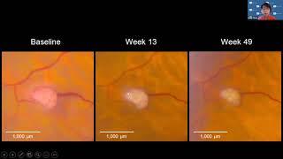 Testing Treatments of Ocular Hemangioblastomas Associated with VHL | Emily Chew, MD