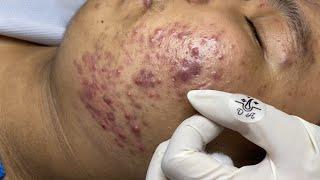 Blackheads & Whiteheads Removal New 2024| Acne Treatment Duyên An Spa #011