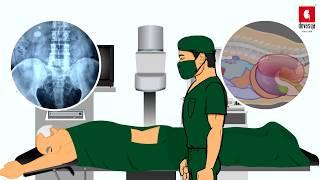 2D Animation Video - Kidney Stone Operation