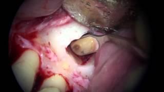 Mandibular premolar endodontic microsurgery