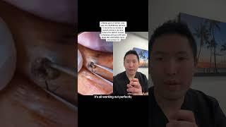 Dermatologist Reacts: Dilated Pore of Winer and Ingrown Hair Extraction