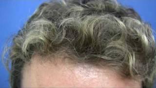 Dr.Jerry Wong - 3525 grafts - One session