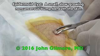 St Elmo's Cyst - Dr Gilmore Treats Sebaceous Cyst