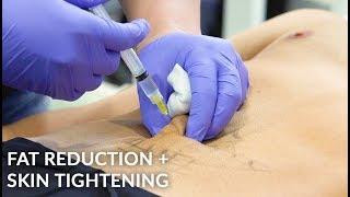 Non-Invasive Fat Reduction | Mesotherapy | Vanquish Radiofrequency | Cellutone Shock Therapy