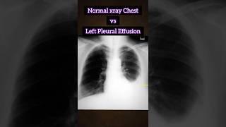 Normal xray vs Pleural Effusion 🩻 🫁 #medical #xray #disease #radiology #infection #shorts