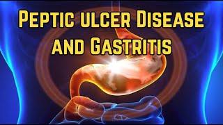 Peptic Ulcer Disease and Gastritis - CRASH! Medical Review Series