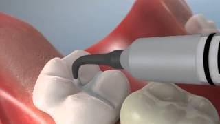 Sealants