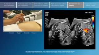 Advanced screening views of the fetal heart - Part 5 - 3-vessel view color Doppler