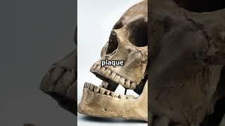 How Did Ancient Humans Avoid Cavities? 