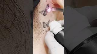 Удаляем БАБОЧЕК на шее   Лазерное удаление татуировки  #tattoo #tattooremoval #top #удалениетату