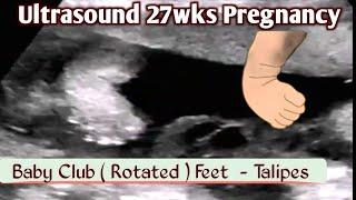 Ultrasound Pregnancy - Both Club Feet Abnormality