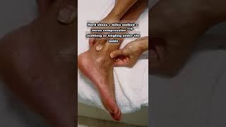 did you feel pain in this area when you walk a lot?  #massage #foottherapy #footmassage #couple