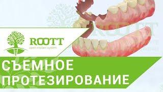 Съемное протезирование.Частично - съемное протезирование после удаления зуба. Клиника ROOTT