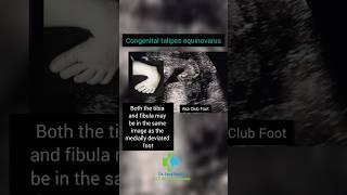 Congenital Talipes Equinovarus aka Club Foot