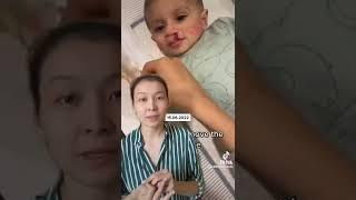 Для чего протез детям?