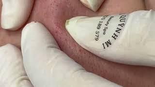 Relaxing Acne Treatment Everyday With Vu Quynh Mi Spa|Blackheads Removal| Cystic Removal 2023 |#01