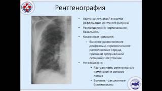 Диагностика обычных интерстициальных пневмоний