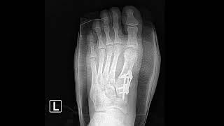 Lapidus Procedure to Correct a #bunion Foot Deformity