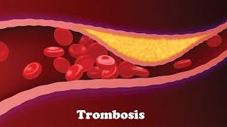 La Trombosis || Medical Toursv