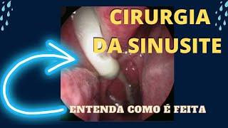 Como é uma cirurgia da sinusite ( sinusite maxilar )