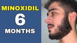 Minoxidil Beard Journey 6 MONTHS TRANSFORMATION