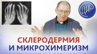 Склеродермия. Системная и локализованная склеродермия. Как развивается склеродермия и что делать.