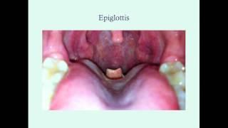 Epiglottitis - CRASH! Medical Review Series