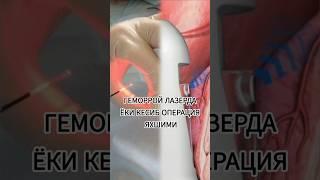 Геморрой кесиб ёки лазер операция қайси яхши / Исчанов