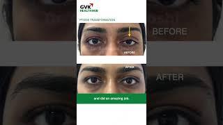 Ptosis surgery journey | Patient Review | Dr. Anamika Joshi | GVK Health Hub