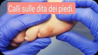 calli sulle dita dei piedi! e scarico posturale.