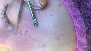 Satifying videos blackhead extraction  | removing cystic acne  |  черные  точки | акне