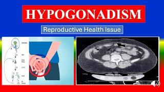 HYPOGONADISM - Definition, types, causes, pathophysiology, symptoms , diagnoses , medicine