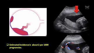 Ultrasound Imaging of the placenta: Part 1 Anatomy and Variants.