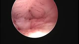 Fantastic Hystroscopic view of endocervical canal by Dr / waleed almery